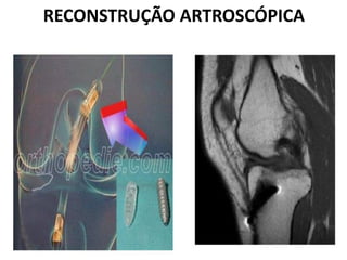 RECONSTRUÇÃO ARTROSCÓPICA
 