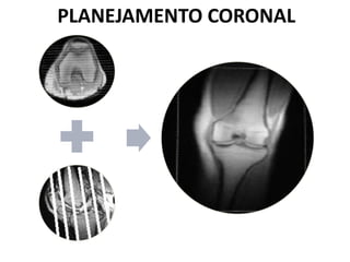 PLANEJAMENTO CORONAL
 