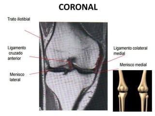 CORONAL
 