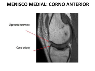 MENISCO MEDIAL: CORNO ANTERIOR
 