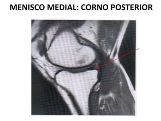MENISCO MEDIAL: CORNO POSTERIOR
 