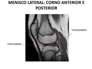 MENISCO LATERAL: CORNO ANTERIOR E
POSTERIOR
 