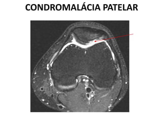 CONDROMALÁCIA PATELAR
 