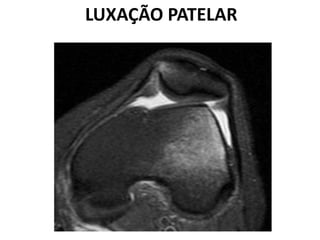 LUXAÇÃO PATELAR
 