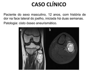 CASO CLÍNICO
Paciente do sexo masculino, 12 anos, com história de
dor na face lateral do joelho, iniciada há duas semanas.
Patologia: cisto ósseo aneurismático.
 