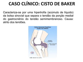 CASO CLÍNICO: CISTO DE BAKER
Caracteriza-se por uma hipertrofia (acúmulo de líquido)
da bolsa sinovial que separa o tendão da porção medial
do gastrocnênio do tendão semimembranoso. Causa:
atrito dos tendões.
 
