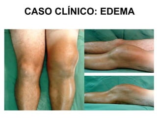 CASO CLÍNICO: EDEMA
 