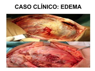 CASO CLÍNICO: EDEMA
 