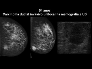 54 anos 
Carcinoma ductal invasivo unifocal na mamografia e US  