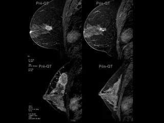 Pré-QTPré-QTPós-QTPós-QT  
