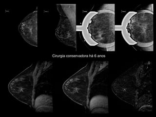 Cirurgia conservadora há 6 anos  