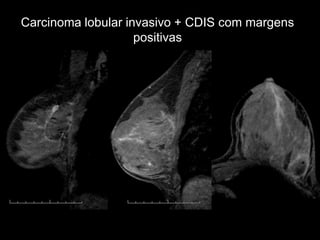 Carcinoma lobular invasivo + CDIS com margens positivas  