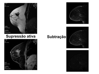 Supressão ativa Subtração  