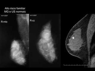 Alto risco familiarMG e US normais  