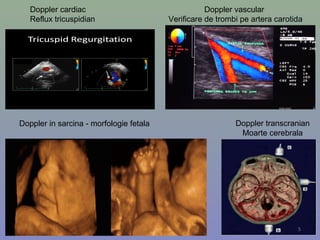 Doppler cardiac
Reflux tricuspidian
Doppler vascular
Verificare de trombi pe artera carotida
Doppler transcranian
Moarte cerebrala
Doppler in sarcina - morfologie fetala
5
 