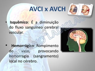 AVCI x AVCH
• Isquêmico: É a diminuição
do fluxo sanguíneo cerebral
vascular.

•

Hemorrágico: Rompimento
do
vaso,
provocando
hemorragia (sangramento)
local no cérebro.

 