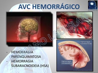 AVC HEMORRÁGICO

- HEMORRAGIA
PARENQUIMATOSA
- HEMORRAGIA
SUBARACNOIDEIA (HSA)

 