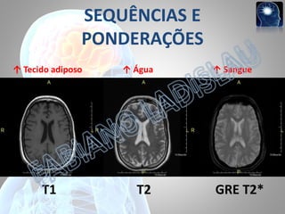 SEQUÊNCIAS E
PONDERAÇÕES
↑ Tecido adiposo

T1

↑ Água

T2

↑ Sangue

GRE T2*

 