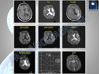 T1
T1

T2
T2

FLAIR
FLAIR

DIFUSÃO
difusão

DIFUSÃO
difusão

ADC

PERFUSÃO
perfusão

ADC

TOF
TOF

 