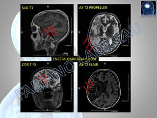 SAG T1

COR T FS

AX T2 PROPELLER

ENCEFALOMALÁCIA GLIOSE
AX T2 FLAIR

 