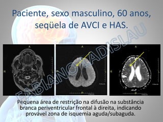 Paciente, sexo masculino, 60 anos,
seqüela de AVCI e HAS.

Pequena área de restrição na difusão na substância
branca periventricular frontal à direita, indicando
provável zona de isquemia aguda/subaguda.

 