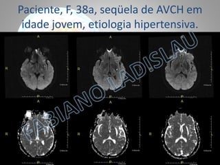 Paciente, F, 38a, seqüela de AVCH em
idade jovem, etiologia hipertensiva.

 