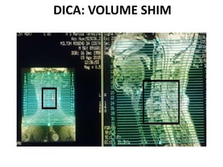 DICA: VOLUME SHIM
 