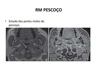RM PESCOÇO
• Estudo das partes moles do
pescoço.
 