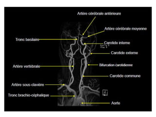 RM PESCOÇO E ANGIO-CARÓTIDAS