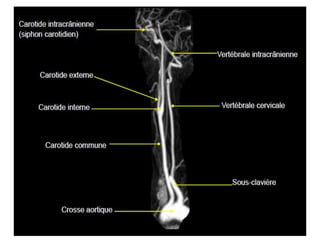 RM PESCOÇO E ANGIO-CARÓTIDAS
