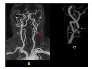 RM PESCOÇO E ANGIO-CARÓTIDAS