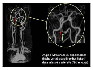 RM PESCOÇO E ANGIO-CARÓTIDAS
