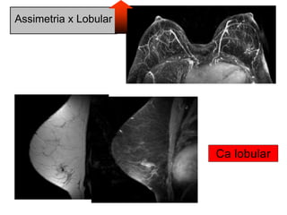 Assimetria x Lobular
 
