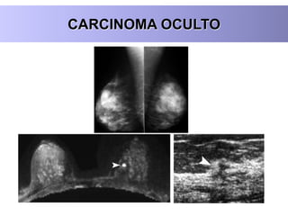 CARCINOMA OCULTO
 