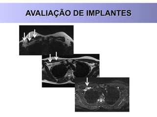 AVALIAÇÃO DE IMPLANTES
 