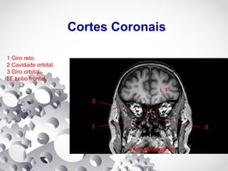 Cortes Coronais
1 Giro reto.
2 Cavidade orbital.
3 Giro orbital.
LF Lobo frontal.
 