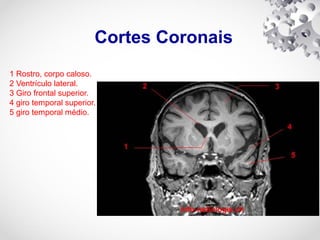 Cortes Coronais
1 Rostro, corpo caloso.
2 Ventrículo lateral.
3 Giro frontal superior.
4 giro temporal superior.
5 giro temporal médio.
 