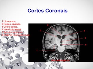 Cortes Coronais
1 Hipocampo.
2 Núcleo caudado.
3 Corpo caloso.
4 Ventrículo lateral.
5 Terceiro ventrículo.
6 Cisterna Inter peduncular.
 