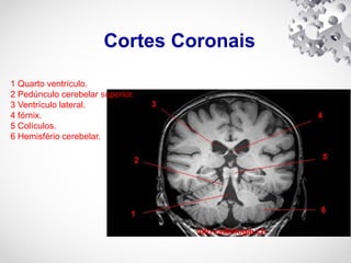 Cortes Coronais
1 Quarto ventrículo.
2 Pedúnculo cerebelar superior.
3 Ventrículo lateral.
4 fórnix.
5 Colículos.
6 Hemisfério cerebelar.
 