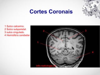 Cortes Coronais
1 Sulco calcarino.
2 Sulco subparietal.
3 sulco cingulado.
4 Hemisfério cerebelar.
 
