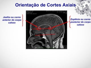 Orientação de Cortes Axiais
Joelho ou corno
anterior do corpo
caloso
Esplênio ou corno
posterior do corpo
caloso
 
