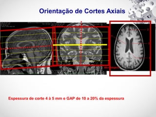 Orientação de Cortes Axiais
Espessura de corte 4 à 5 mm e GAP de 10 a 20% da espessura
 