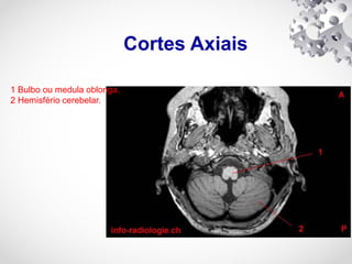 Cortes Axiais
1 Bulbo ou medula oblonga.
2 Hemisfério cerebelar.
 