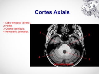 Cortes Axiais
1 Lobo temporal (direito).
2 Ponte.
3 Quarto ventrículo.
4 Hemisfério cerebelar.
 