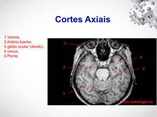Cortes Axiais
1 Vermis.
2 Artéria basilar.
3 globo ocular (direito).
4 úncus.
5 Ponte.
 