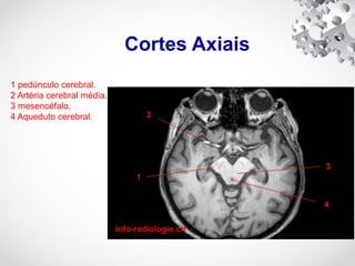 Cortes Axiais
1 pedúnculo cerebral.
2 Artéria cerebral média.
3 mesencéfalo.
4 Aqueduto cerebral.
 