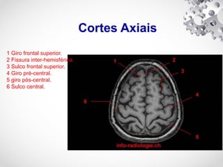 Cortes Axiais
1 Giro frontal superior.
2 Fissura inter-hemisférica.
3 Sulco frontal superior.
4 Giro pré-central.
5 giro pós-central.
6 Sulco central.
 