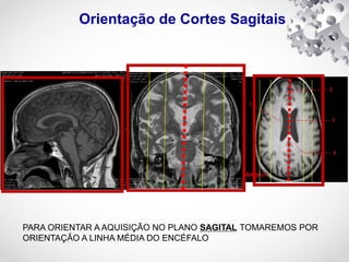 Orientação de Cortes Sagitais
PARA ORIENTAR A AQUISIÇÃO NO PLANO SAGITAL TOMAREMOS POR
ORIENTAÇÃO A LINHA MÉDIA DO ENCÉFALO
 