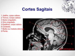 Cortes Sagitais
1 Joelho, corpo caloso.
2 Tronco, Corpo caloso.
3 Sulco cingulado .
4 Giro cingulado.
5 Esplênio, corpo caloso.
6 Cerebelo.
7 Bulbo ou medula oblonga.
8 Ponte.
 
