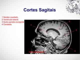 Cortes Sagitais
1 Núcleo caudado.
2 Ventriculo lateral.
3 Sulco parieto-occippital.
4 Cerebelo.
 